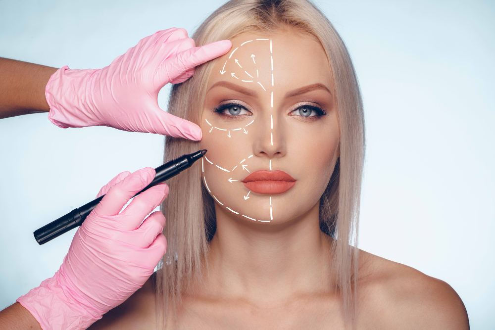 Facelift surgery