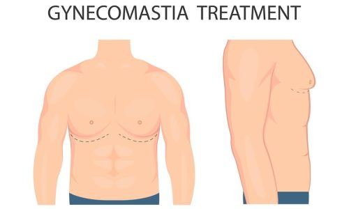 Gynecomastia